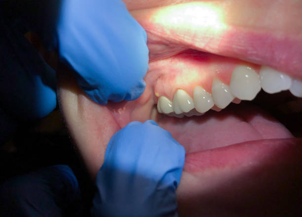 Best Walk-In Emergency Dentist in Haverford College, PA